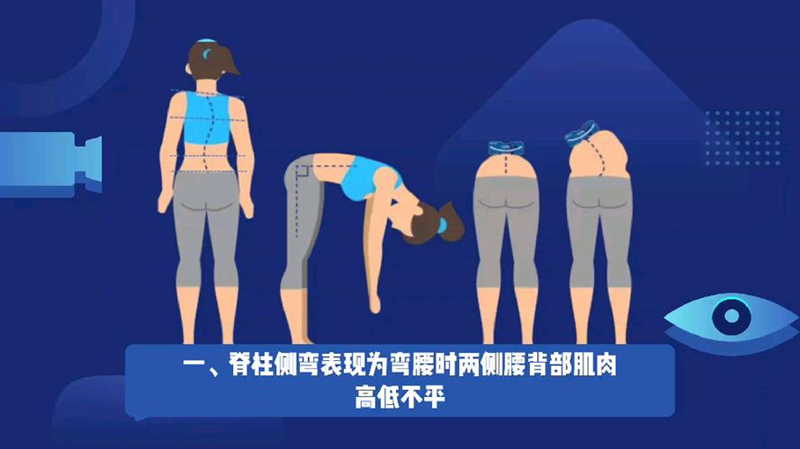 脊柱側(cè)彎彎腰測試