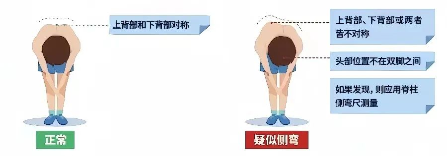 脊柱側(cè)彎篩查測試