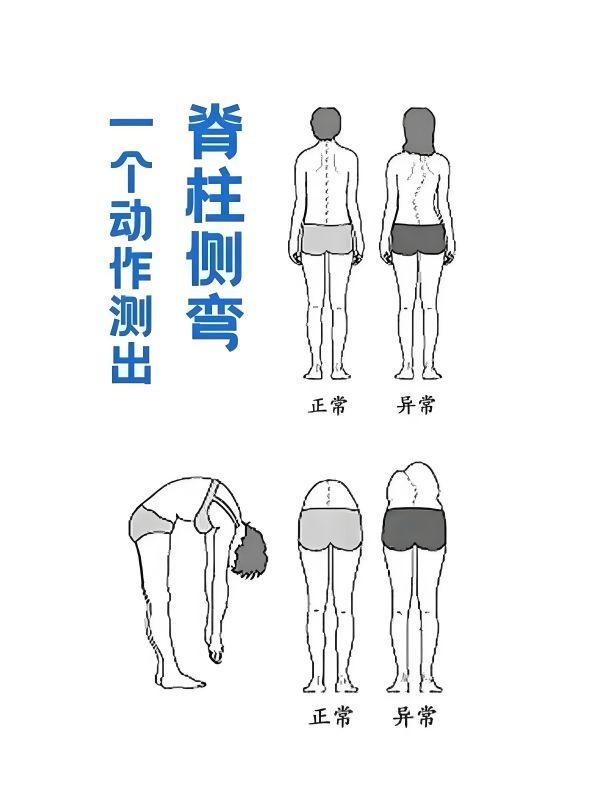 脊柱側彎自測方法