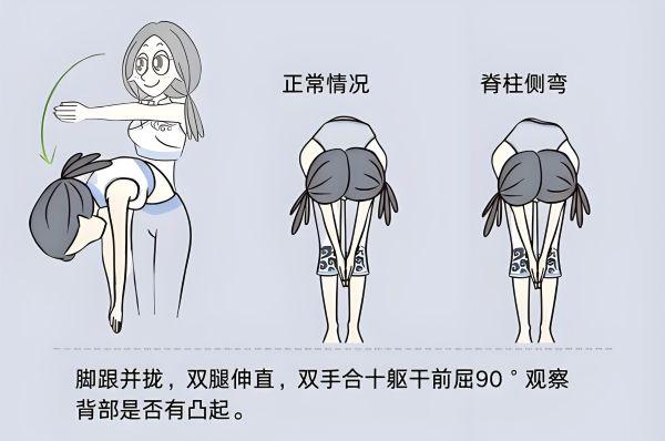 脊柱側(cè)彎自查方法